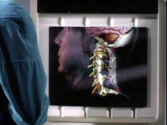 ...a na rentgenu bytost spojenou s jeho nervovou soustavou, která ho, zdá se, zcela ovládá.